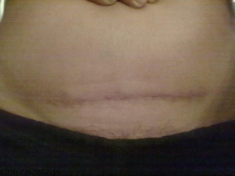 moja blizna dzisiaj.jpg